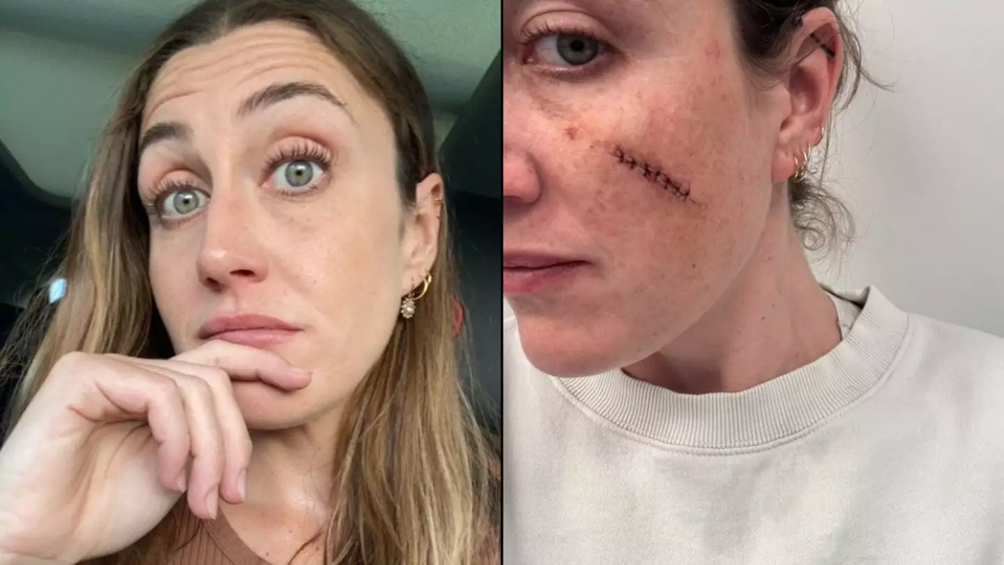 Woman who thought blemish on face was just a spot issues warning after left needing 30 stitches