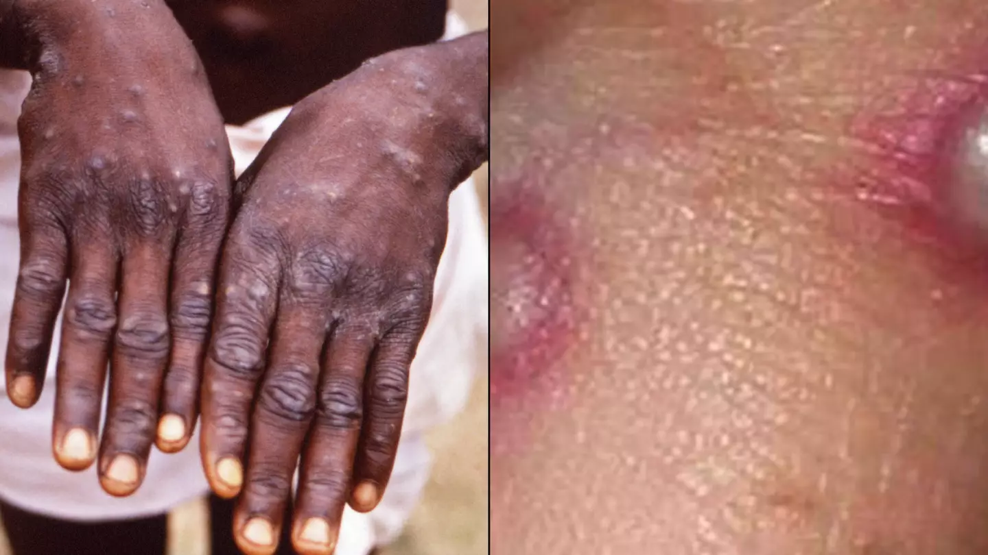 UK Government Orders Monkeypox Contacts To Self Isolate For Three Weeks As More Cases Confirmed