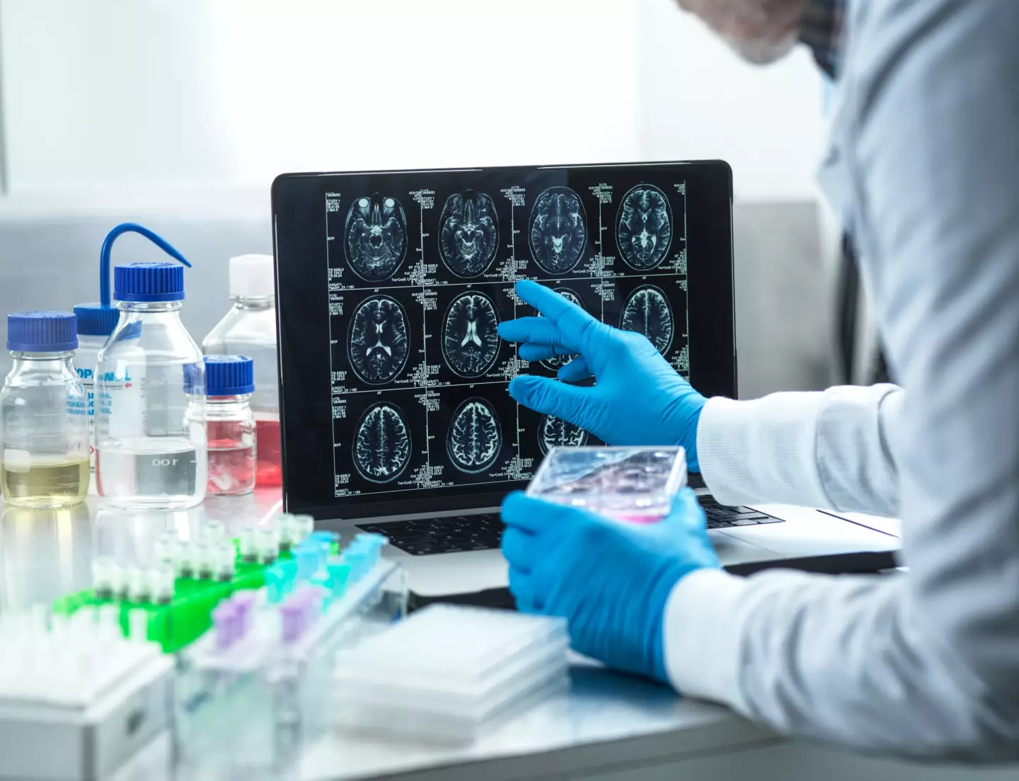 The doctor said he'd been able to slow his Alzheimer's with changes to his lifestyle. (Getty Stock Photo)