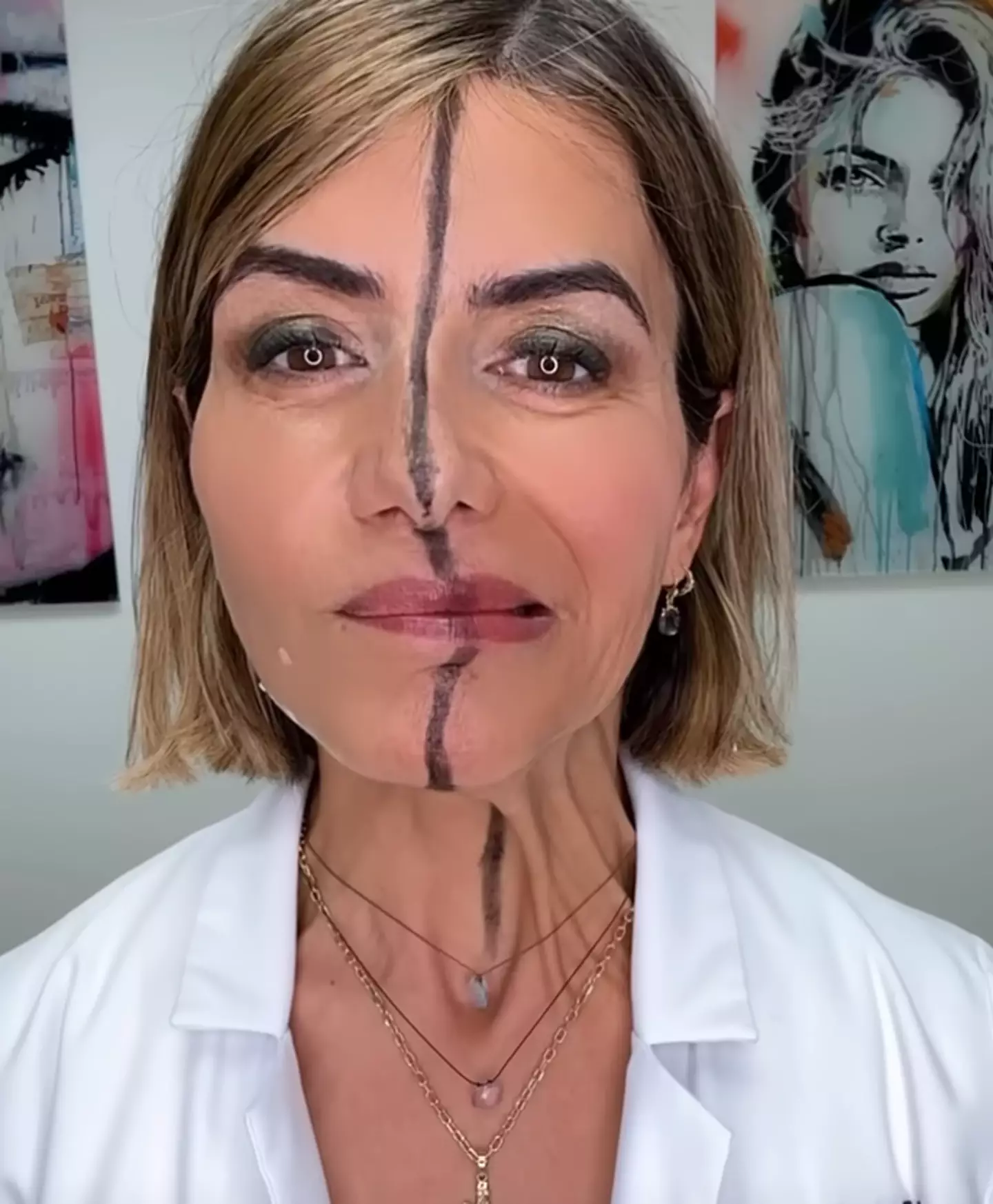 The un-injected side was a lot more mobile than the one which had been blasted with Botox two weeks earlier. (Instagram/@drbitafarrell)