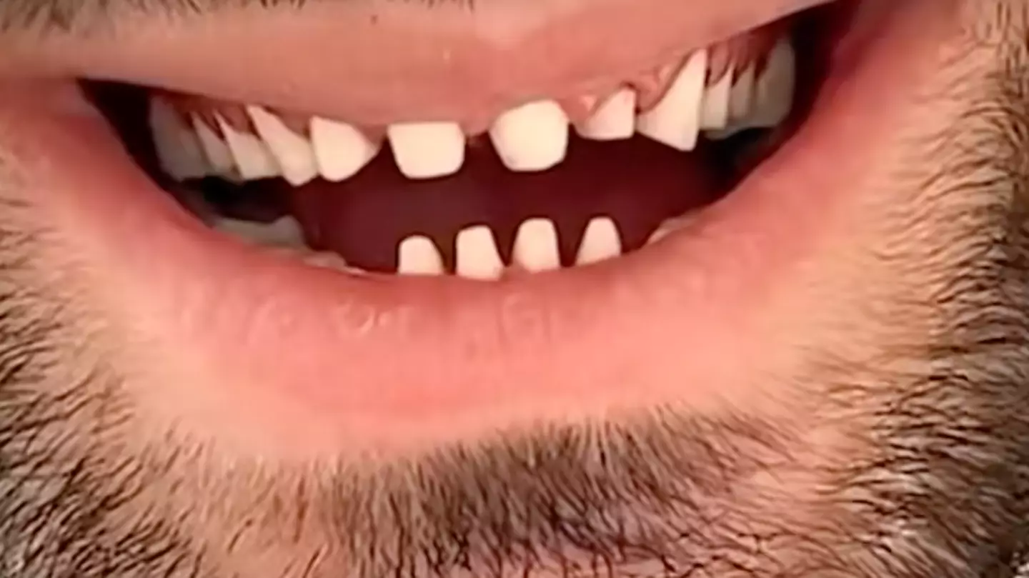 Dentist exposes the dark side of people going for 'Turkey teeth'