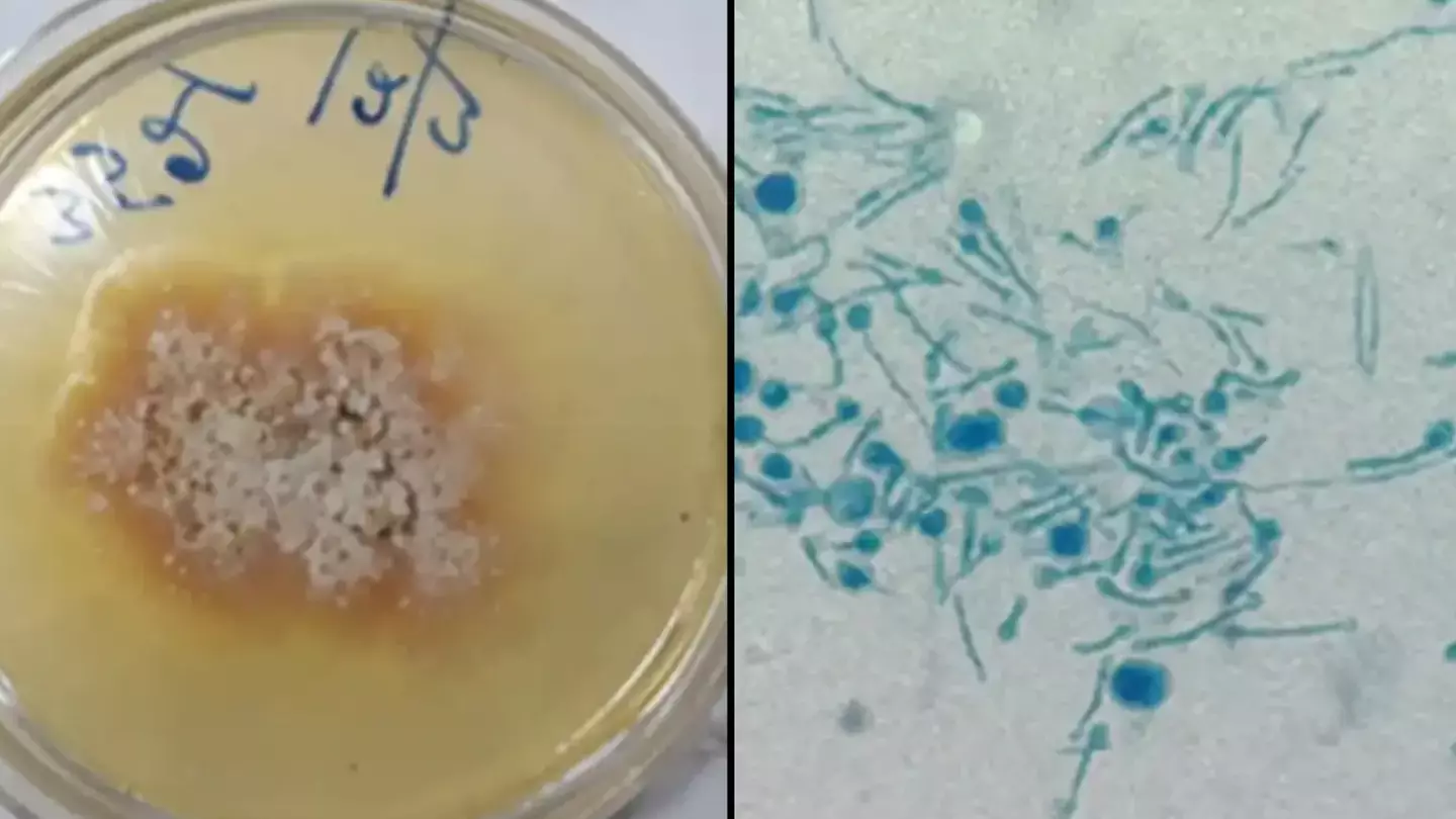 Man becomes first known person to be infected by killer plant fungus