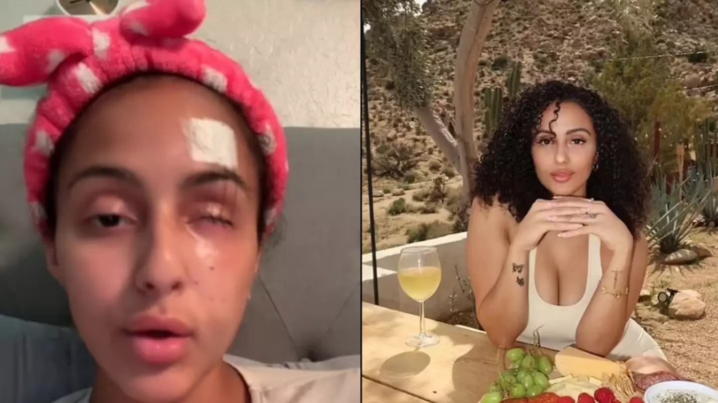 Woman explains what happened after losing her eye during ‘traumatic’ freak accident while walking dog