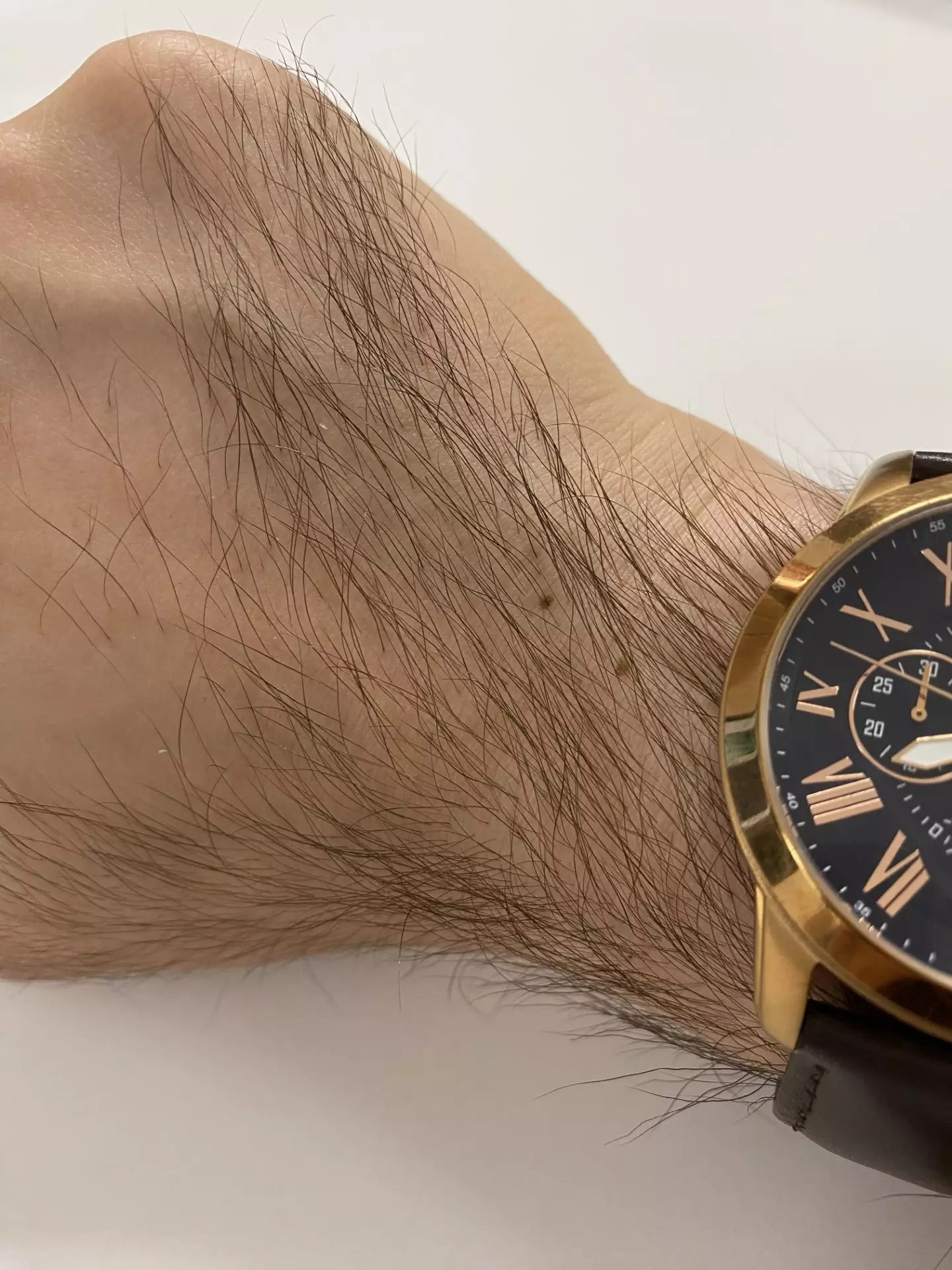 I have a spare hand/wrist freckle if anybody is feeling left out (Supplied)