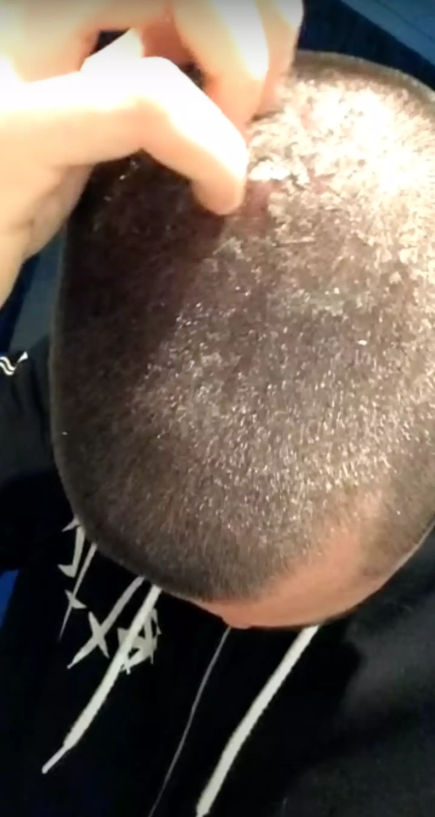 A lot has changed from Aidan's initial 'grotesque flake infestation' on his scalp.