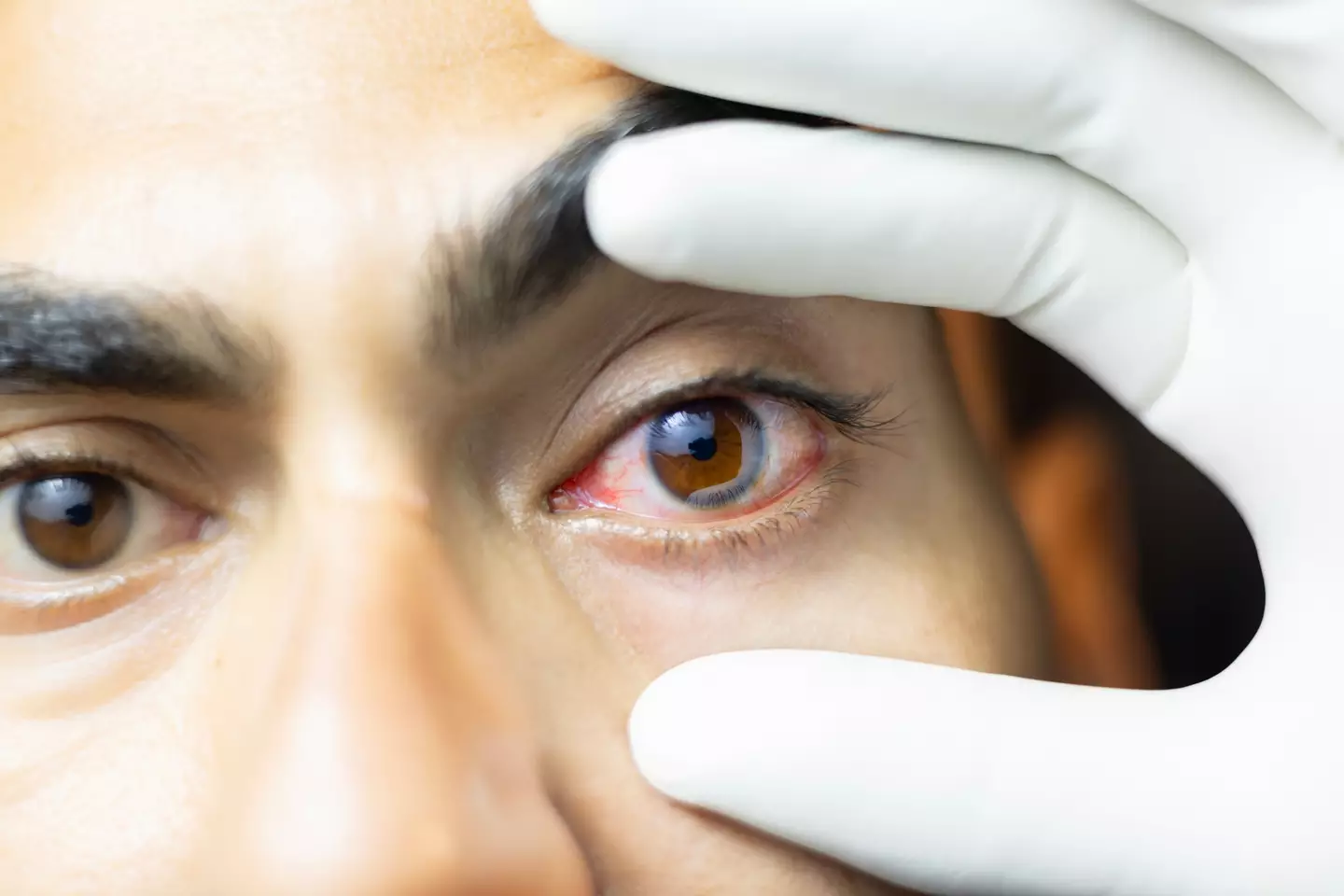 Brits who suffer from a common eye condition can receive financial support from the DWP (Getty Stock Photo)