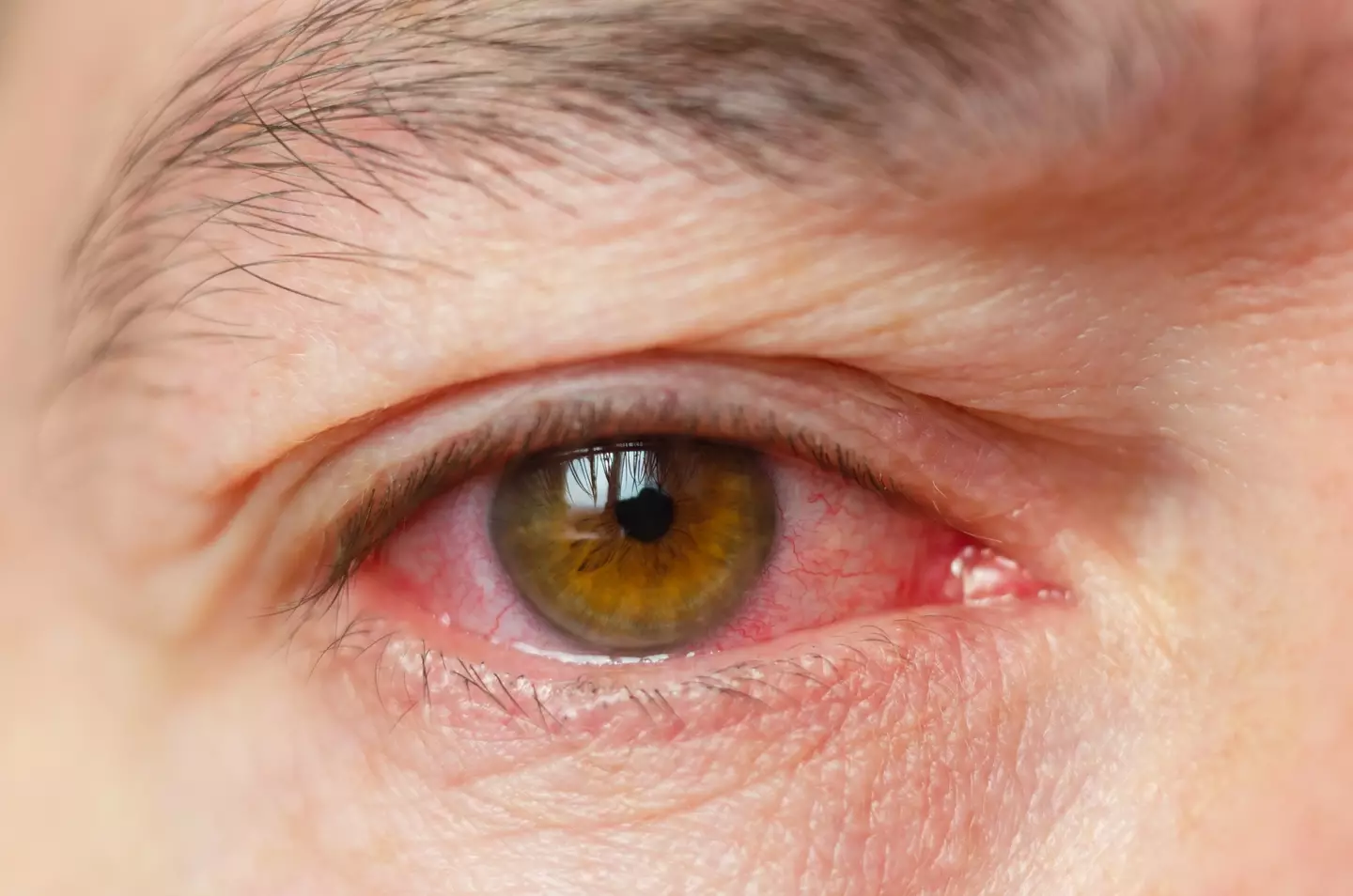 Eye infections are common, but can be serious (Getty Stock Images)