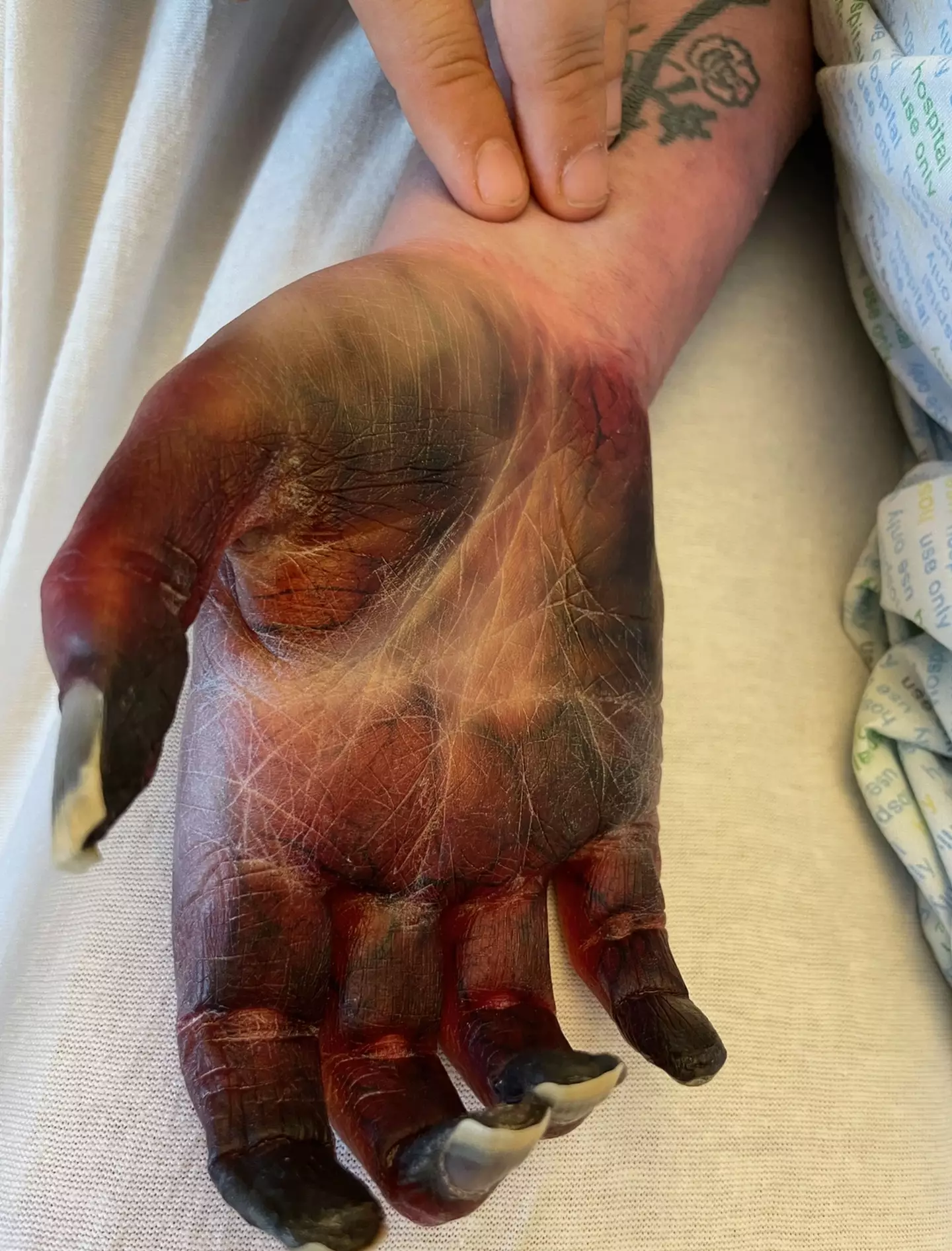 The mum's hand was discoloured as it was necrotic (Kennedy News and Media)