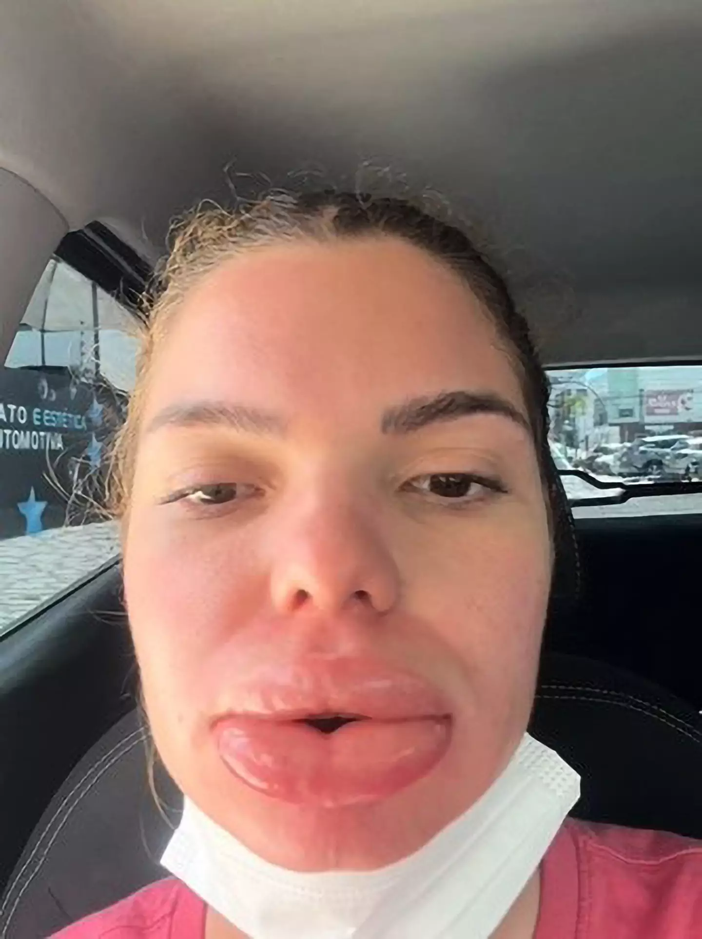 Nutritionist Barbara Martiniano was left in agony after having lip filler.