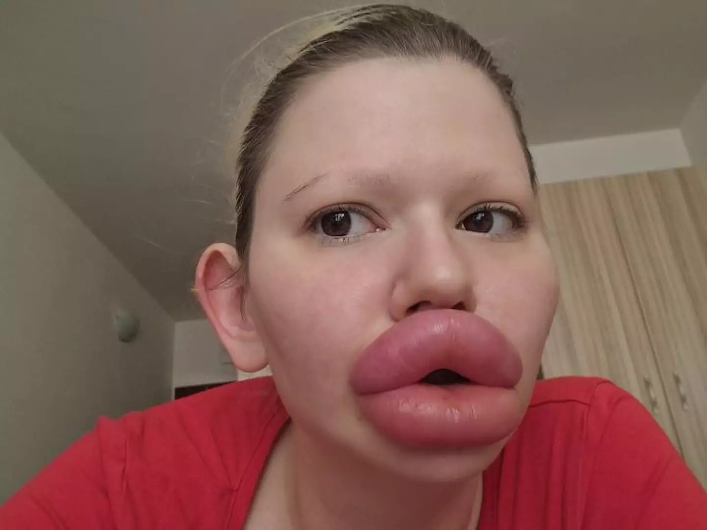 Andrea after spending over $26,000 on lip filler (JamPress)