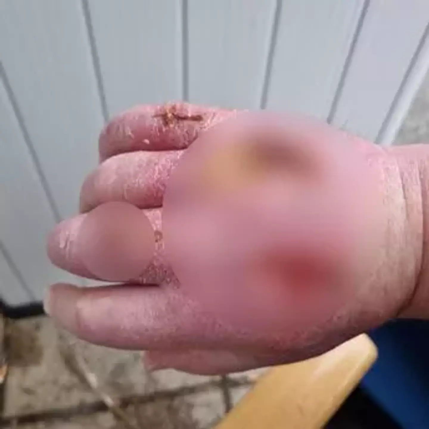 Doctors considered amputating his arm.