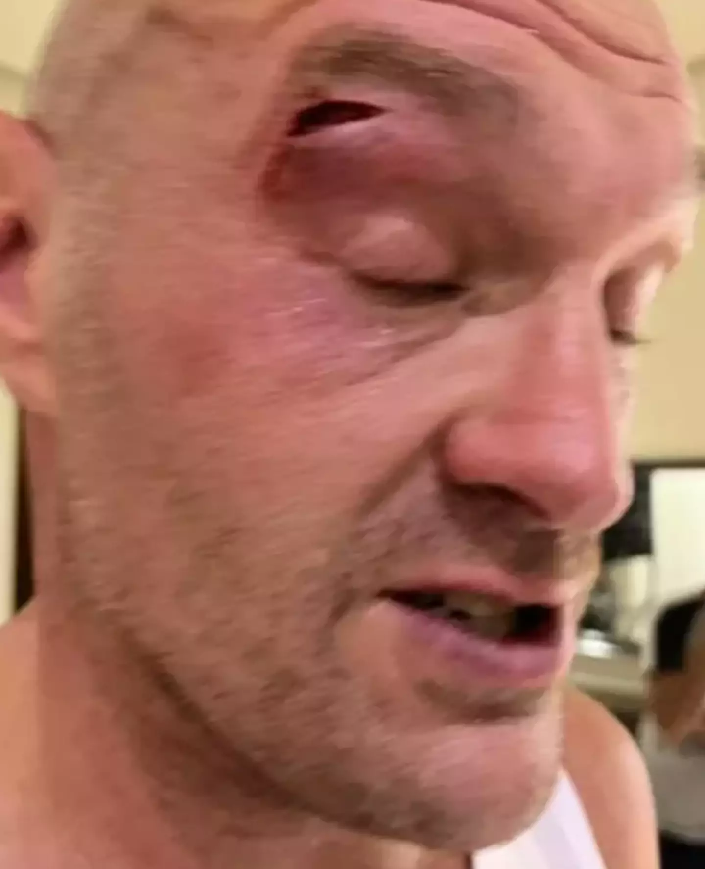 Fury's fight with Usyk has been postponed as a result of him sustaining an injury.