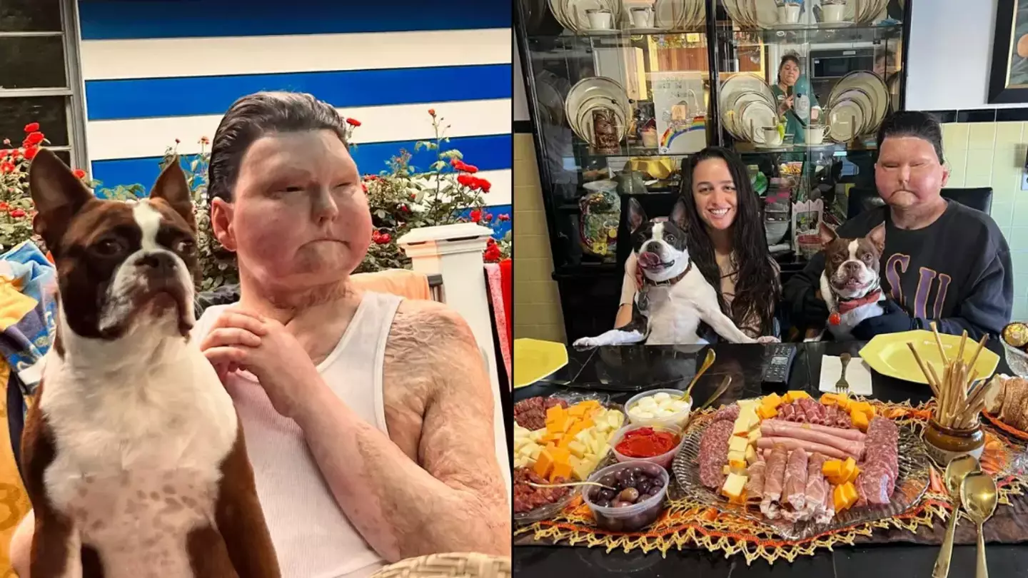 Man who had world’s first successful face and double hand transplant spoke out about life-changing car crash