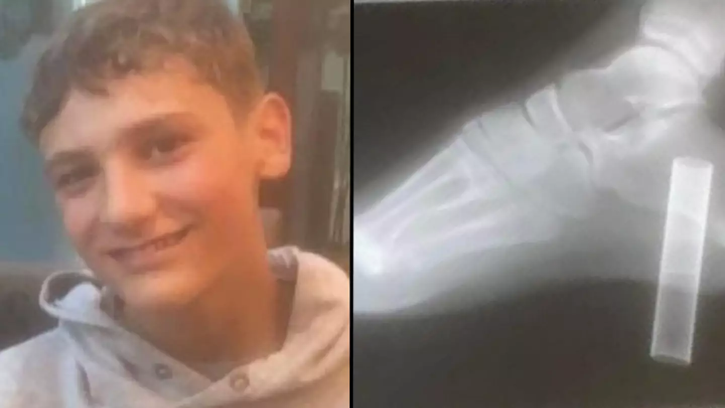 Boy nearly has to have his foot amputated after being impaled by vape