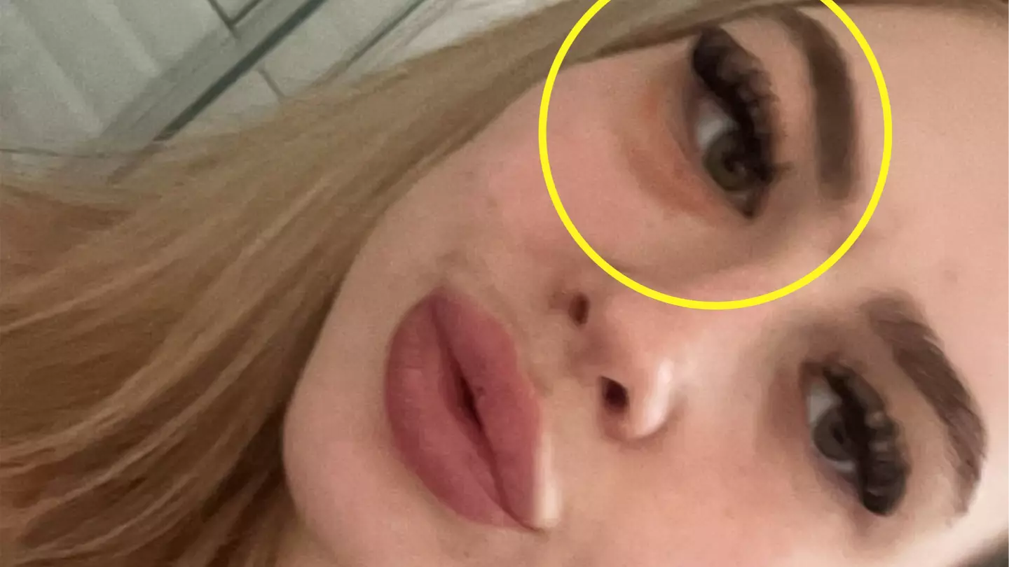 19-year-old wore fake eyelashes to cover 'black eye' dismissed by doctors before discovering rare form of cancer