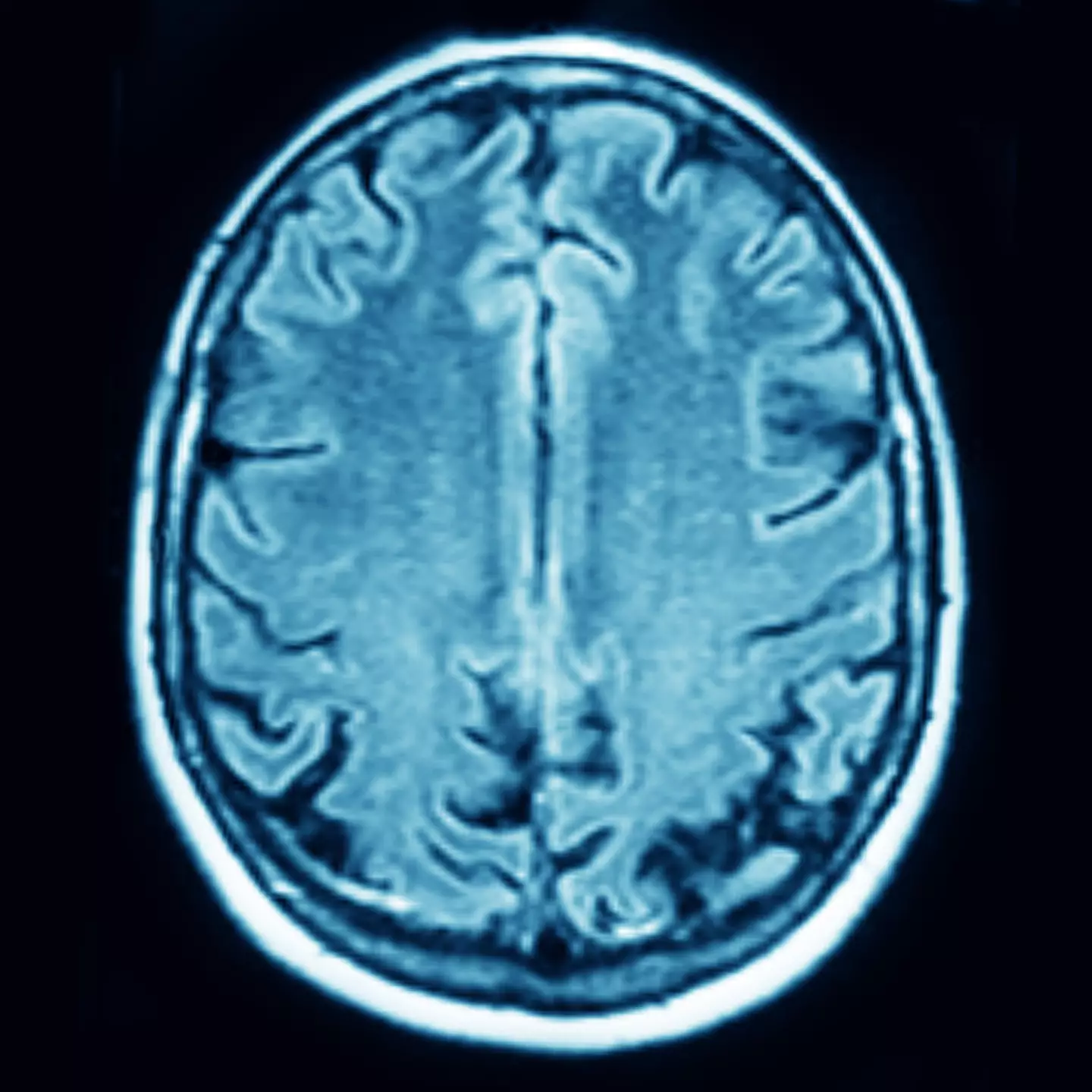 Aphasia impacts the brain's understanding of language (Alamy)