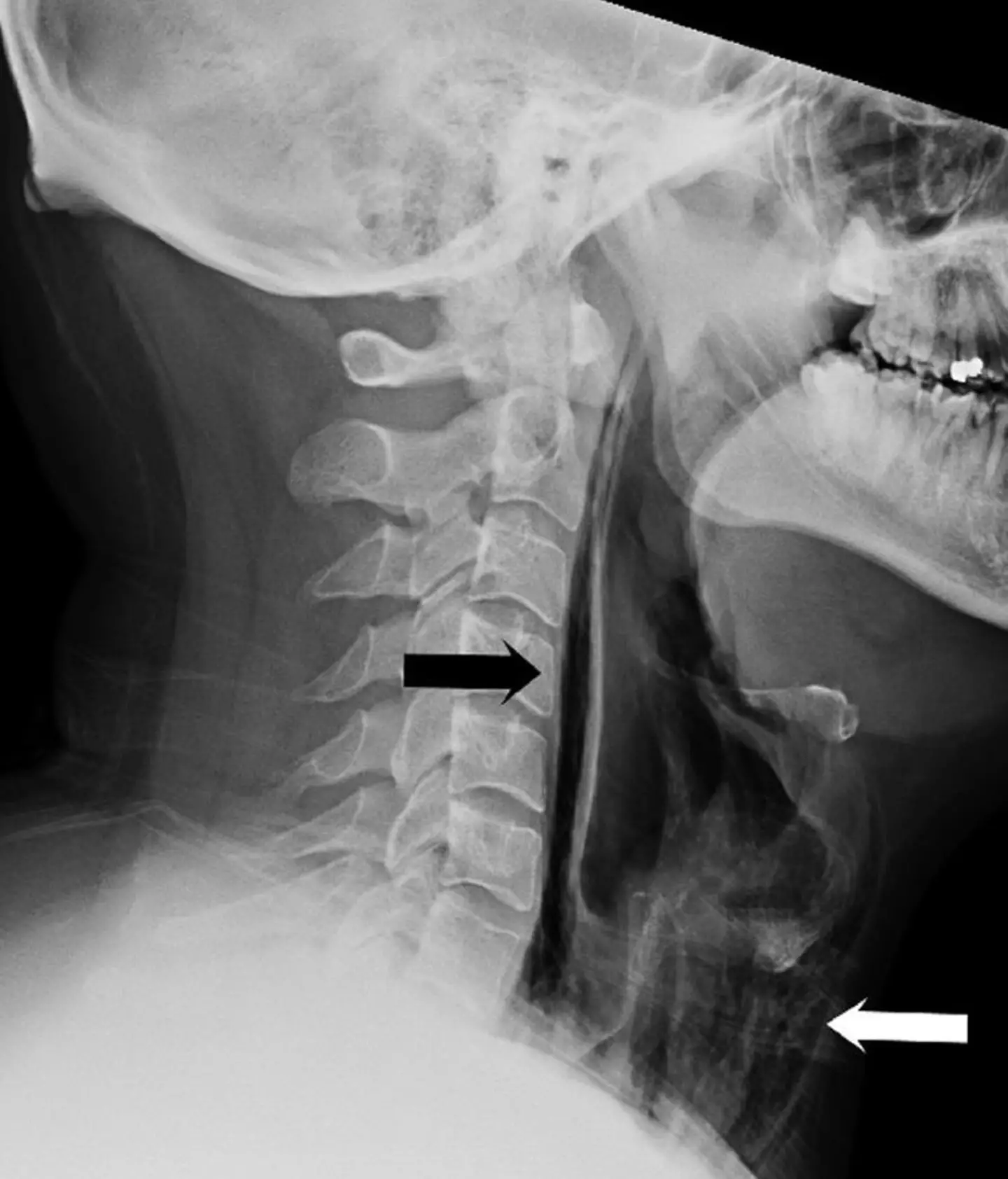 A man was left with a hole in his throat after holding in a sneeze.