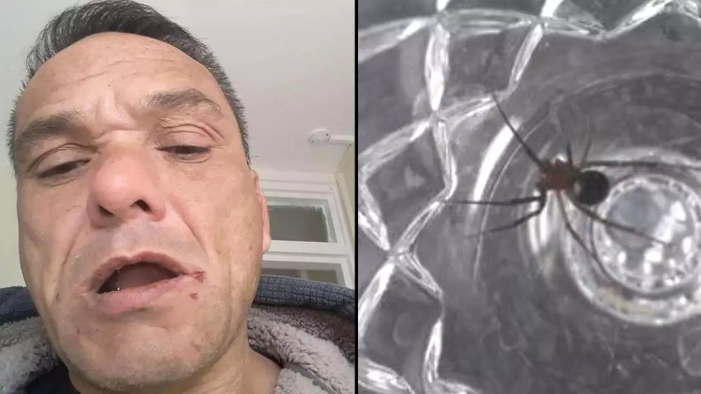 Man Says He's Been Bitten More Than 100 Times By False Widow Spiders Living In Flat