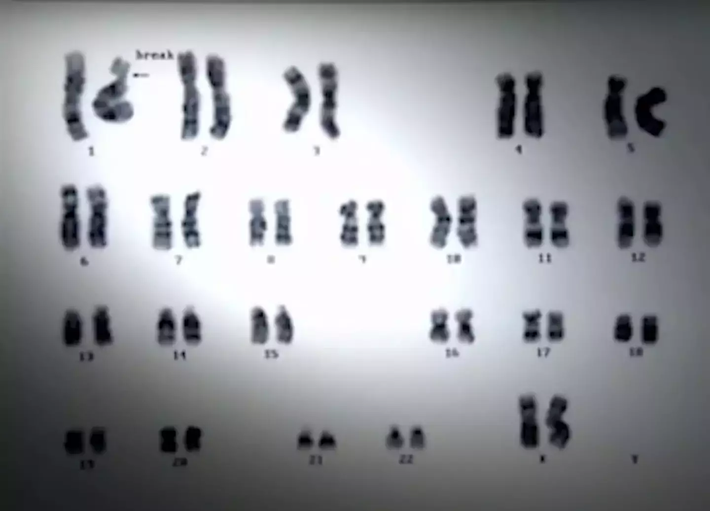 His family insisted that doctors try to keep him alive, despite his DNA and immune system being destroyed (Peaked Interest/YouTube)