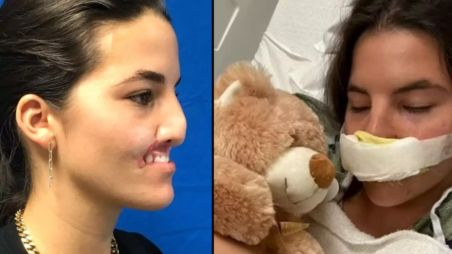 Model who had lip bitten off by dog shows off final surgery to face