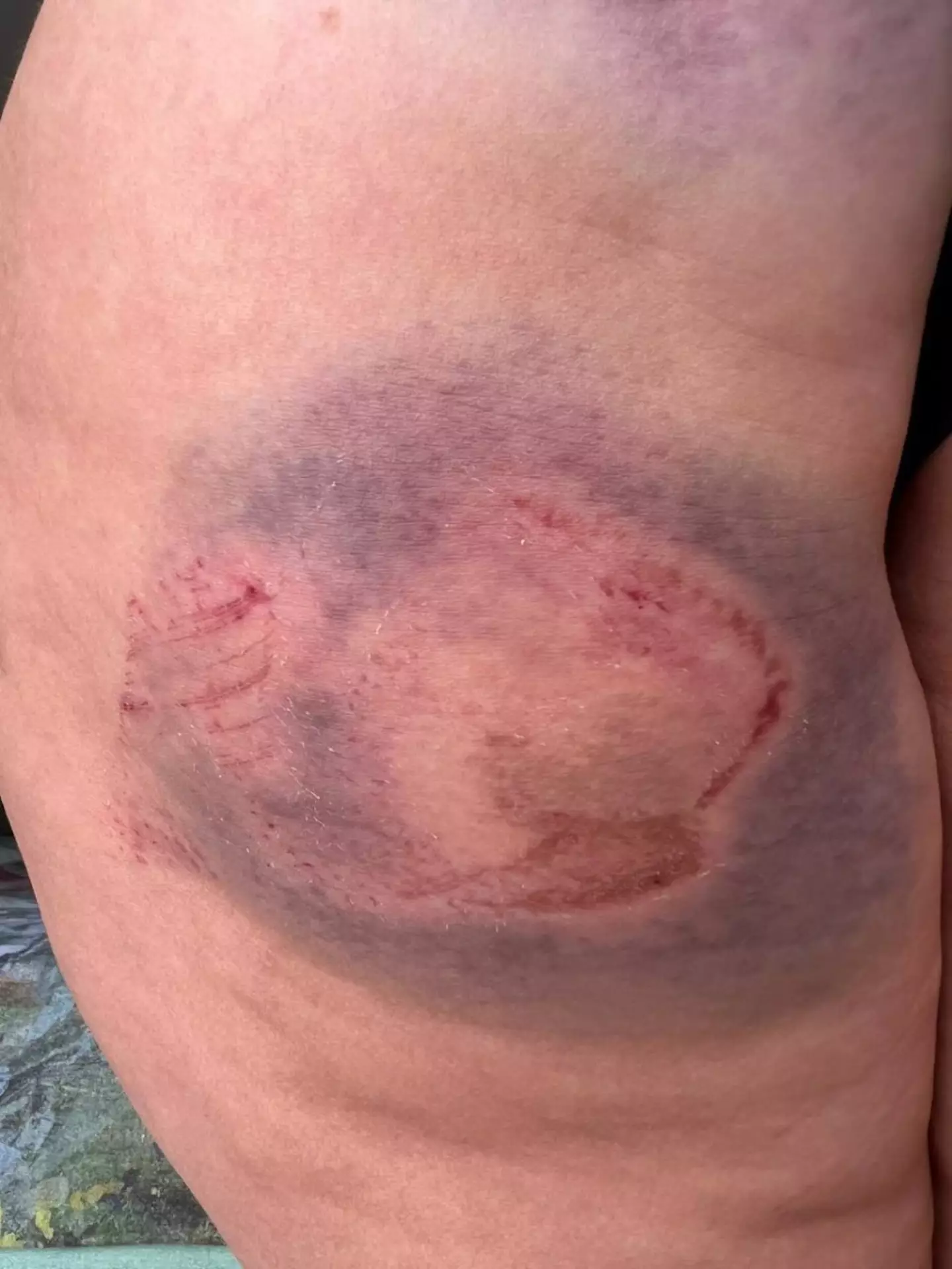 The attack left the tourist with significant bruises.