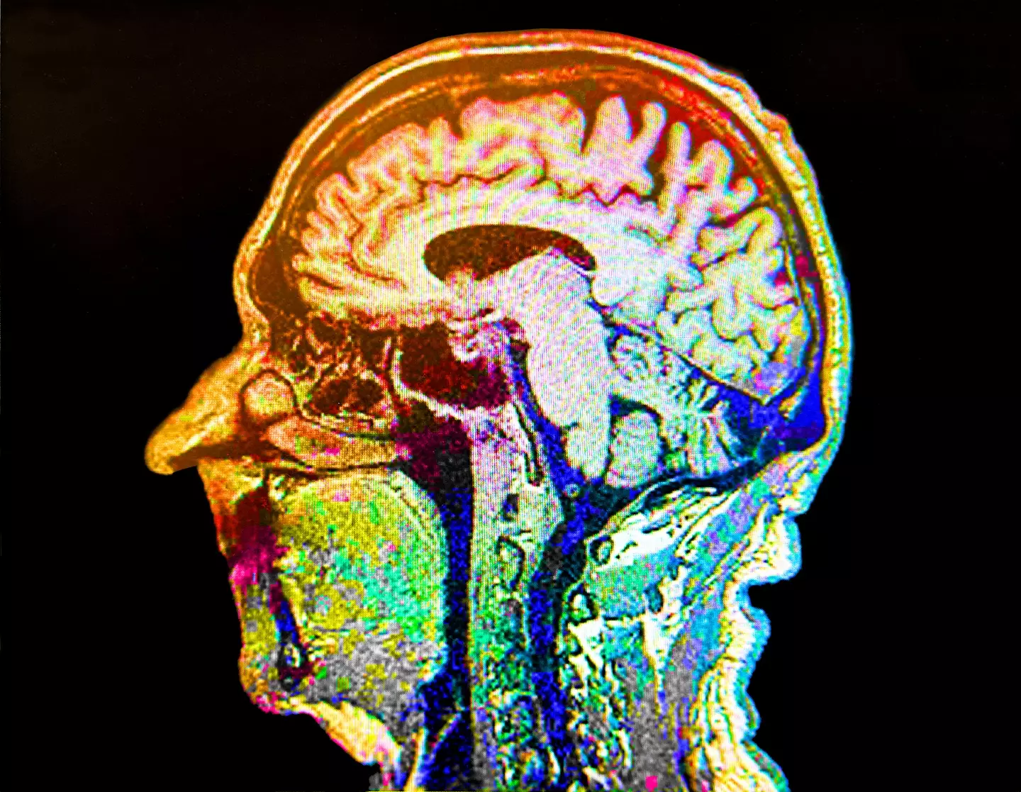 Conditions that affect your mind, if they progress, can lead to Alzheimer's (Peter Dazeley/Getty Images)