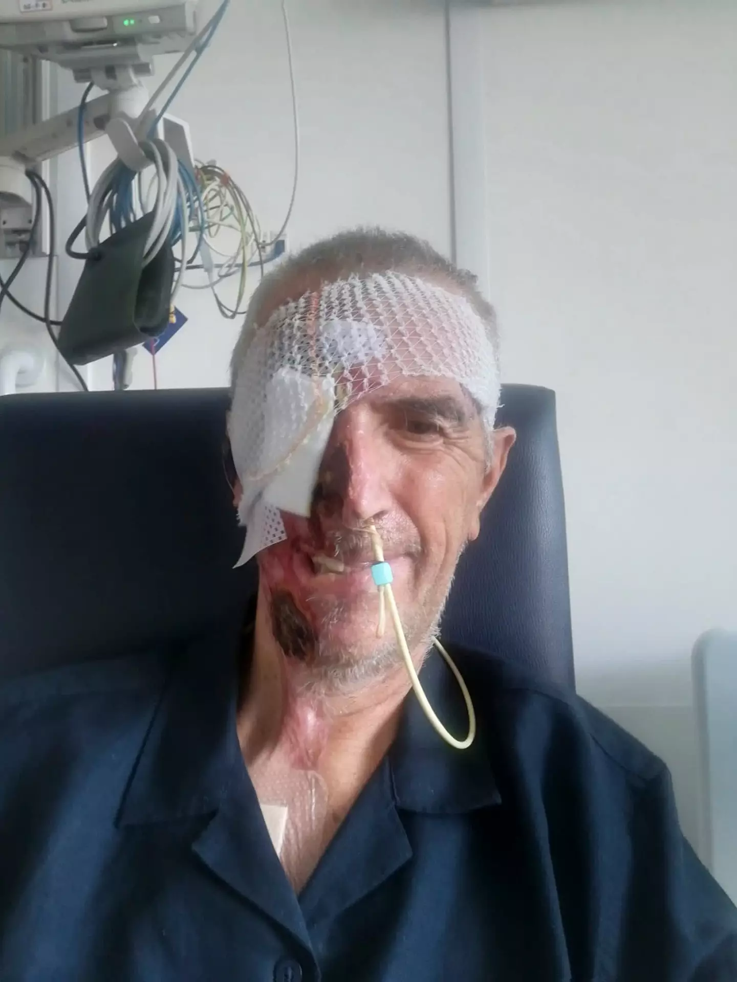 Surgeons worked to save his face before the 3D printing (SWNS)