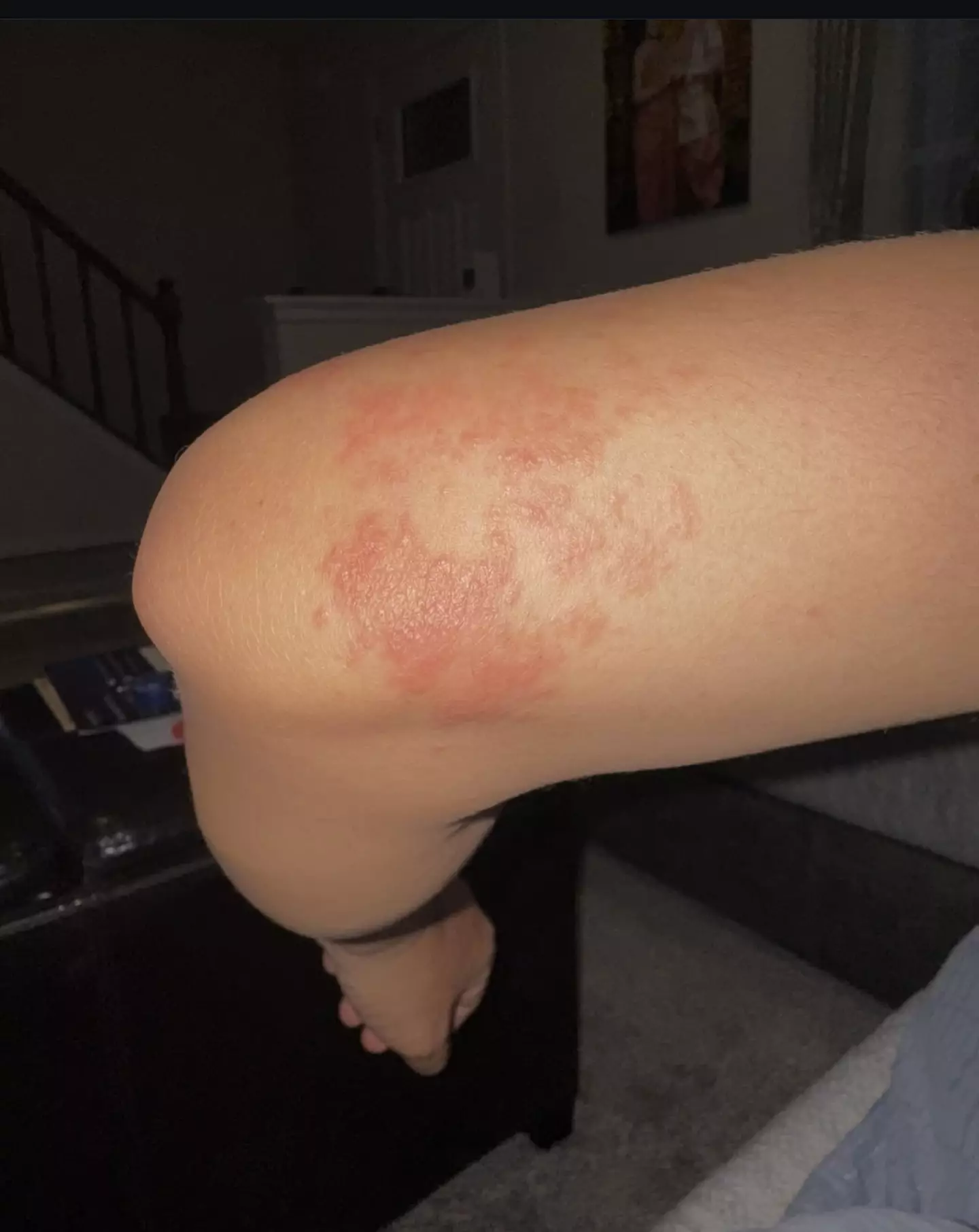 The rash spread to her legs, and she was unable to sleep in the same bed as her husband (Kennedy News and Media)