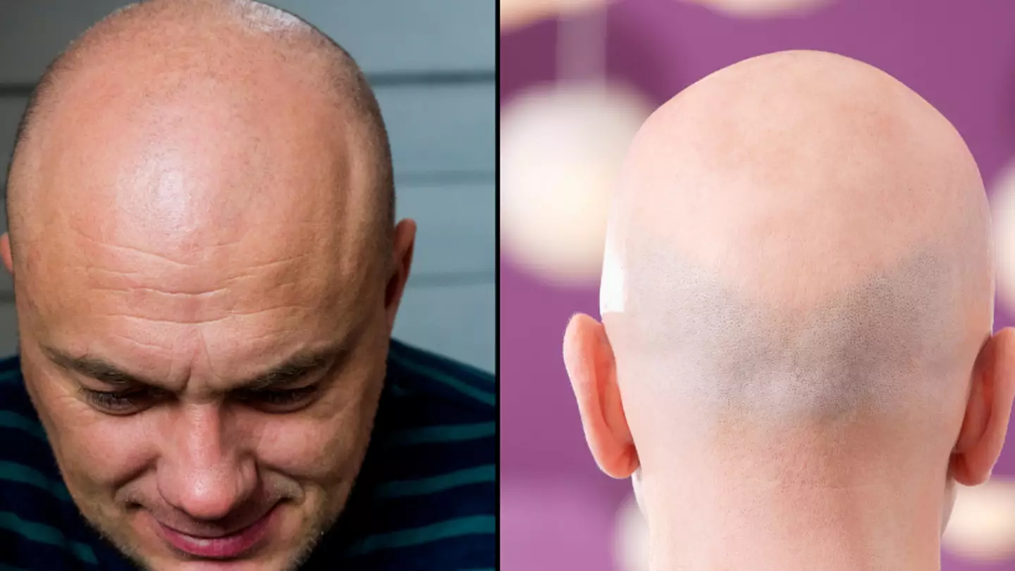 Judge Rules Calling Men Bald Is Sexual Harassment