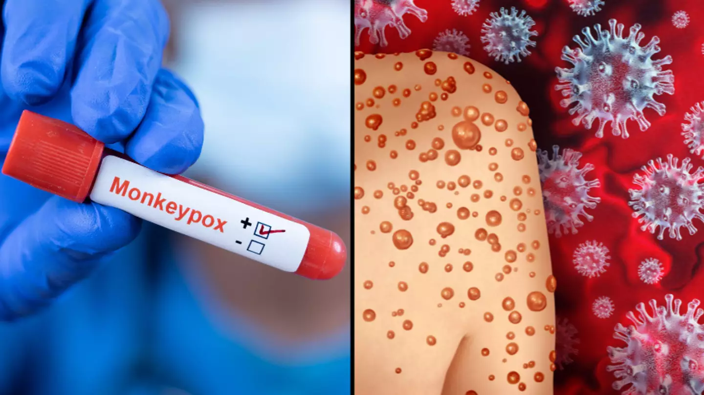 World Health Organization Is Renaming Monkeypox Over Fears It's 'Discriminatory'