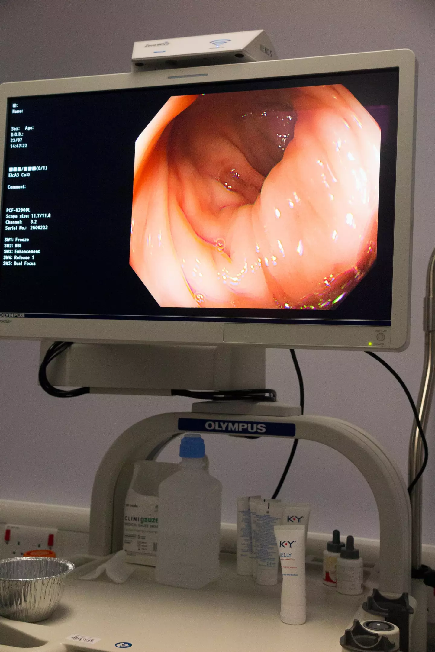 A bowel scope screening test.