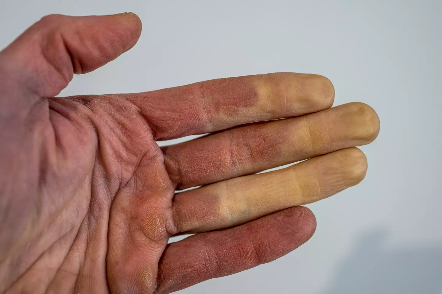 Pale white fingers is a common symptom of Reynaud's (Getty Stock Images)