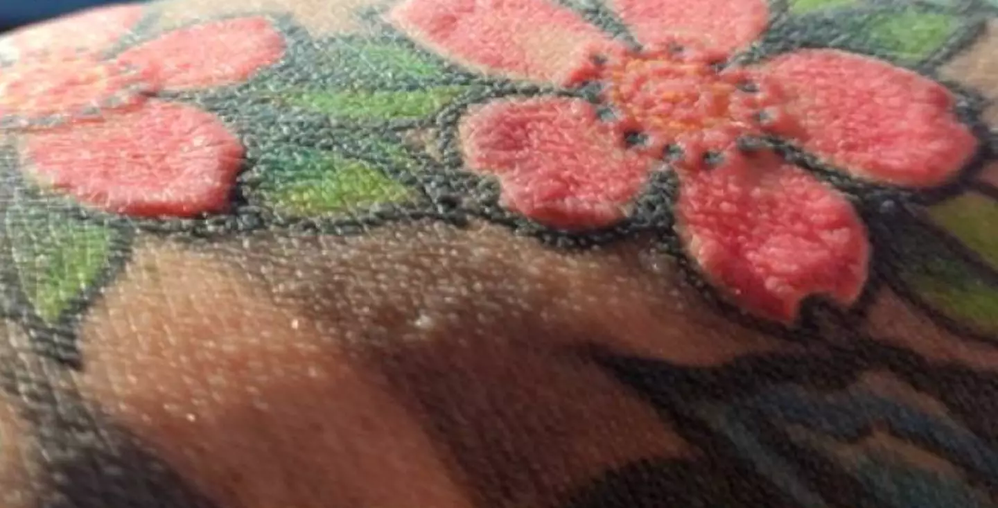 Experts believe that the substances in the tattoo ink caused these problems (Mateuszczyk MK et. al (2025))