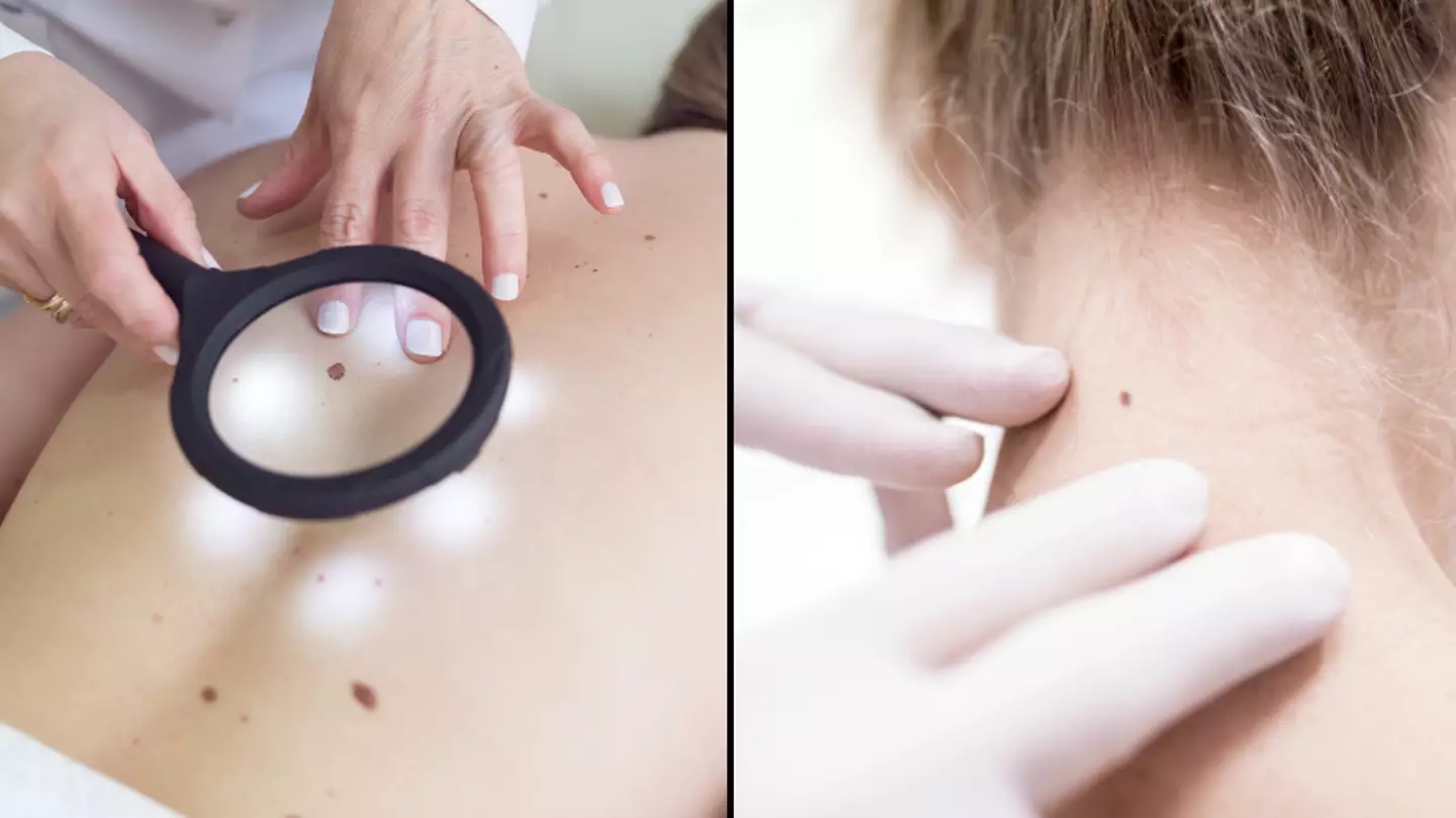 Doctor shares five main 'red flag' signs to look out for that could mean skin mole is cancerous