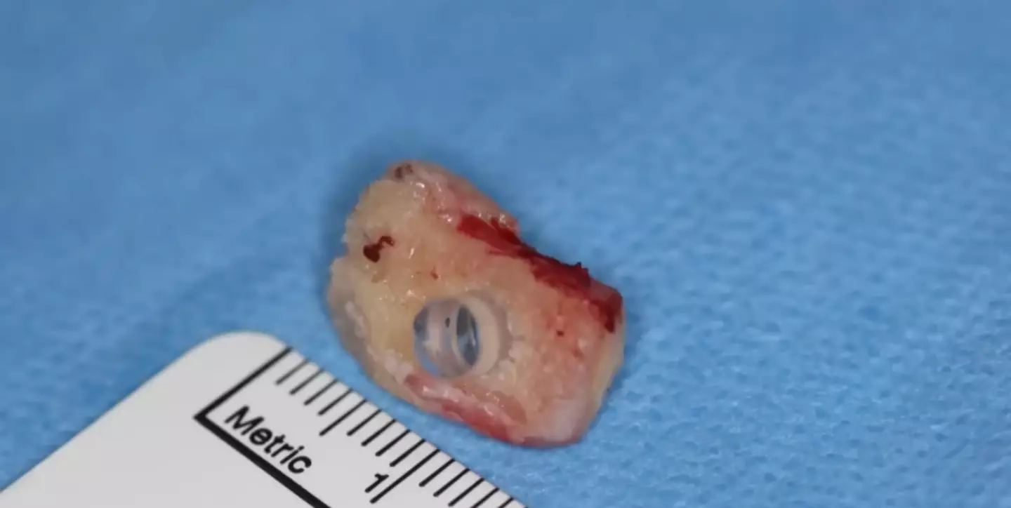 Dr Greg Moloney incredibly implanted a lens in his patient's own tooth, which was then stitched into his eye socket (YouTube/CBSChicago)