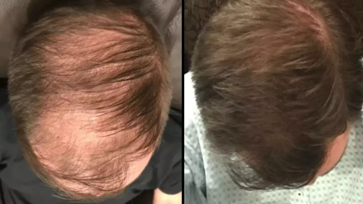 Barbers ‘can’t believe’ results of little-known men’s hair loss hack