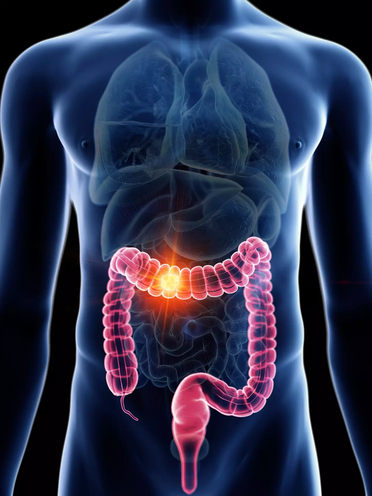 Colon cancer is a rising issue among younger adults (Getty Stock Photo)
