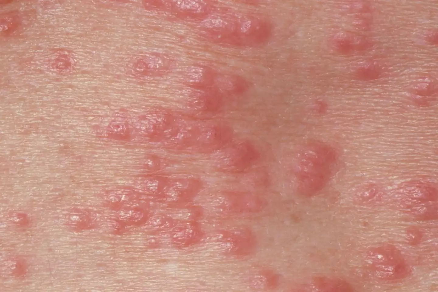 Scabies is when tiny mites lay eggs in the skin (NHS)