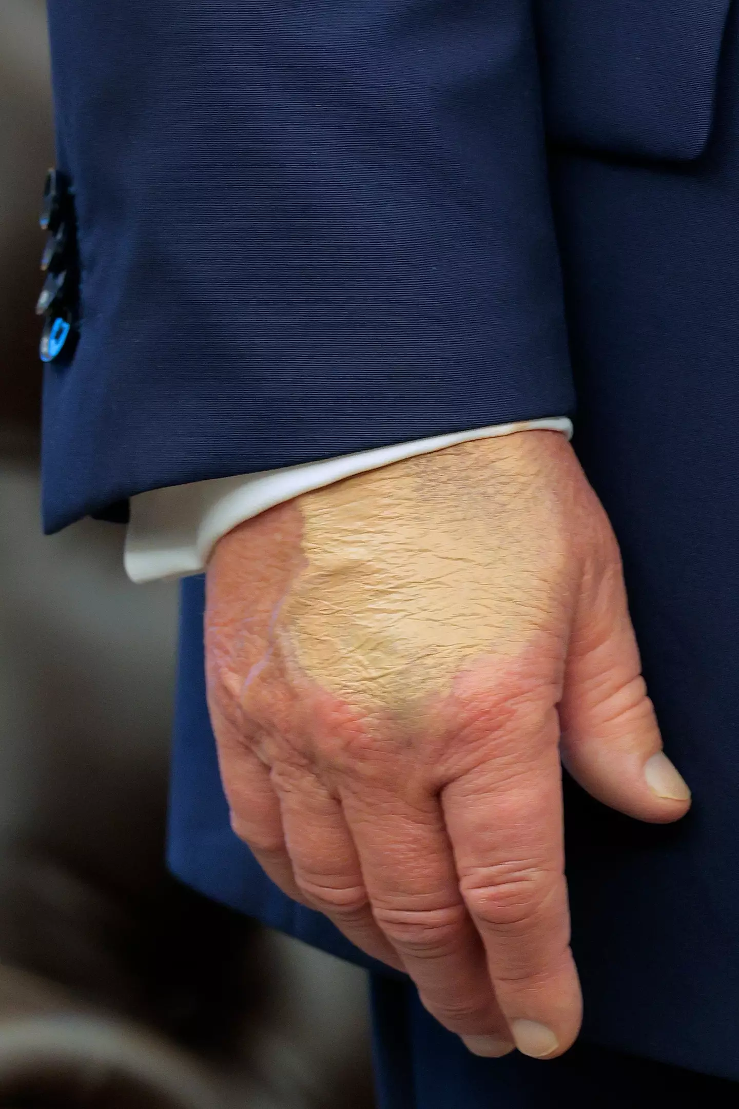 People said this was a 'bruise cover up' (Chip Somodevilla/Getty Images)