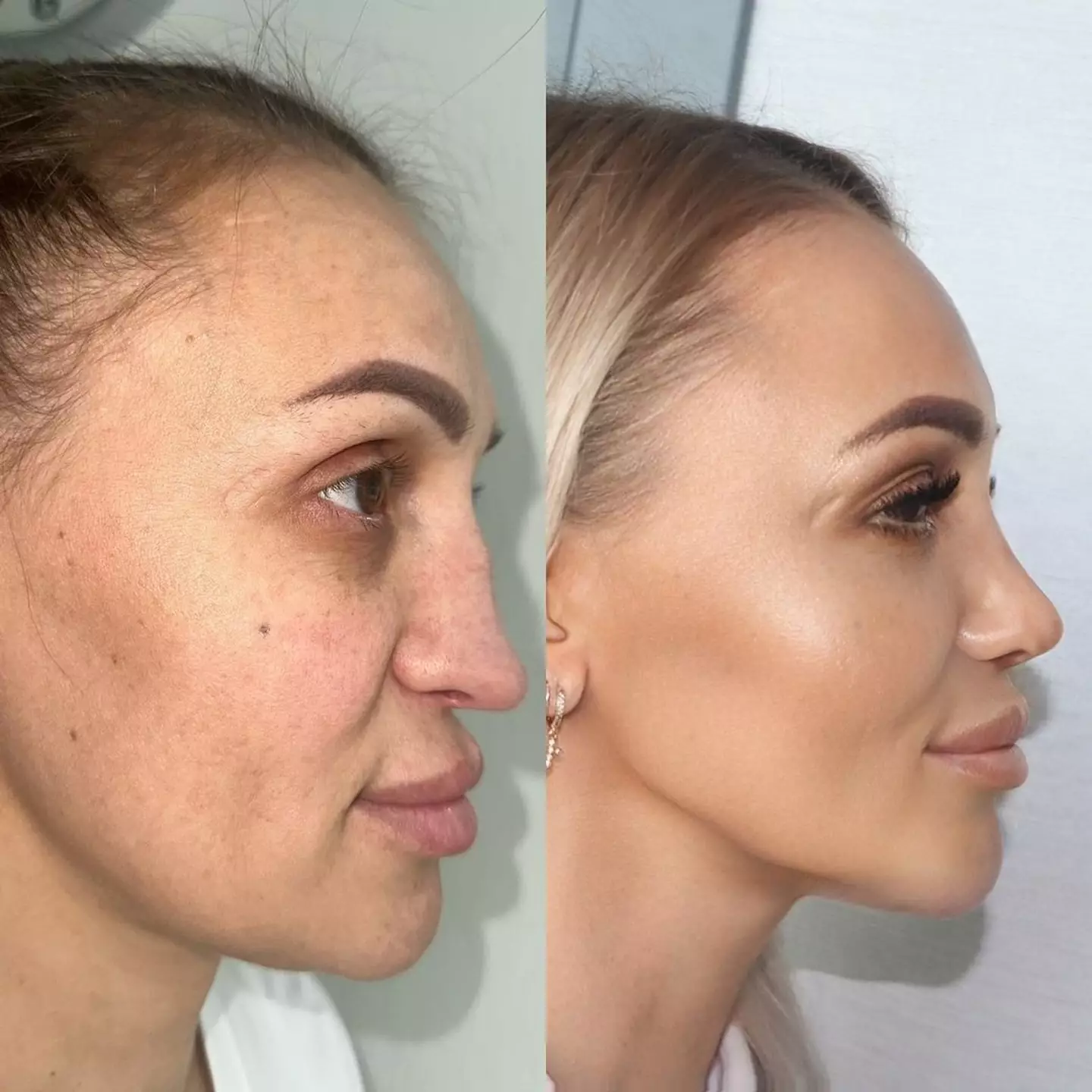 The side profile of her new transformation. (Instagram/@esteistanbultr)