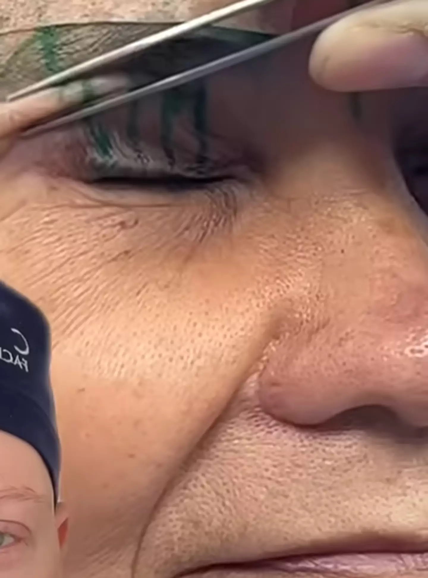 The doctor reacted to the before and after of a blepharoplasty procedure (YouTube/DrGaryLinkov)