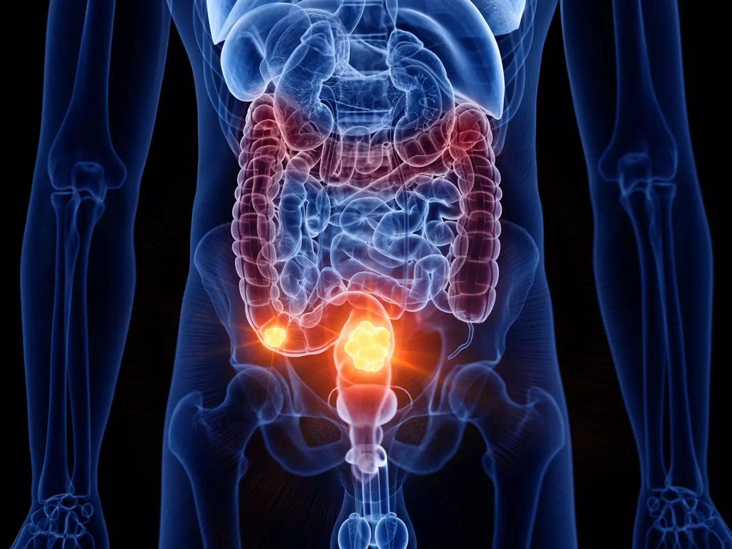 The trial resulted in none of the patients showing any cancer signs for months after the surgery (Getty Stock Photo)