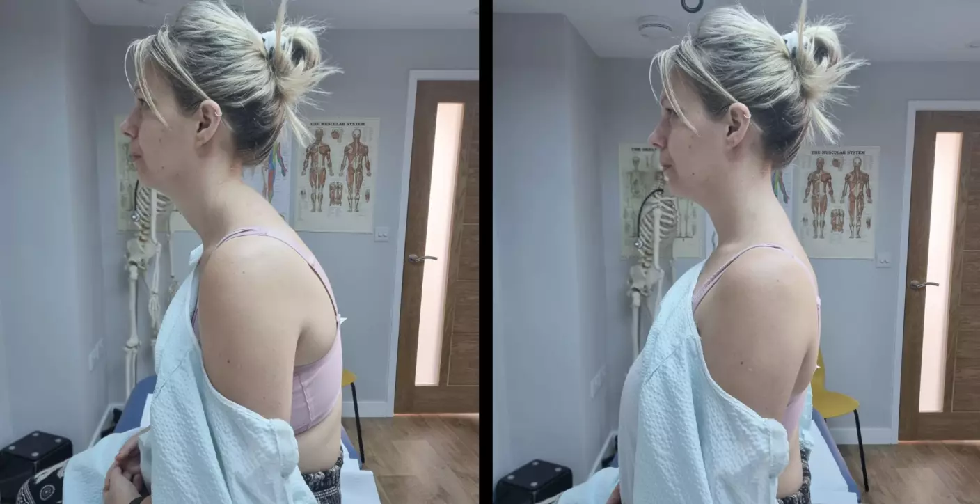 She says she is living in chronic pain and has posture problems. (GoFundMe)