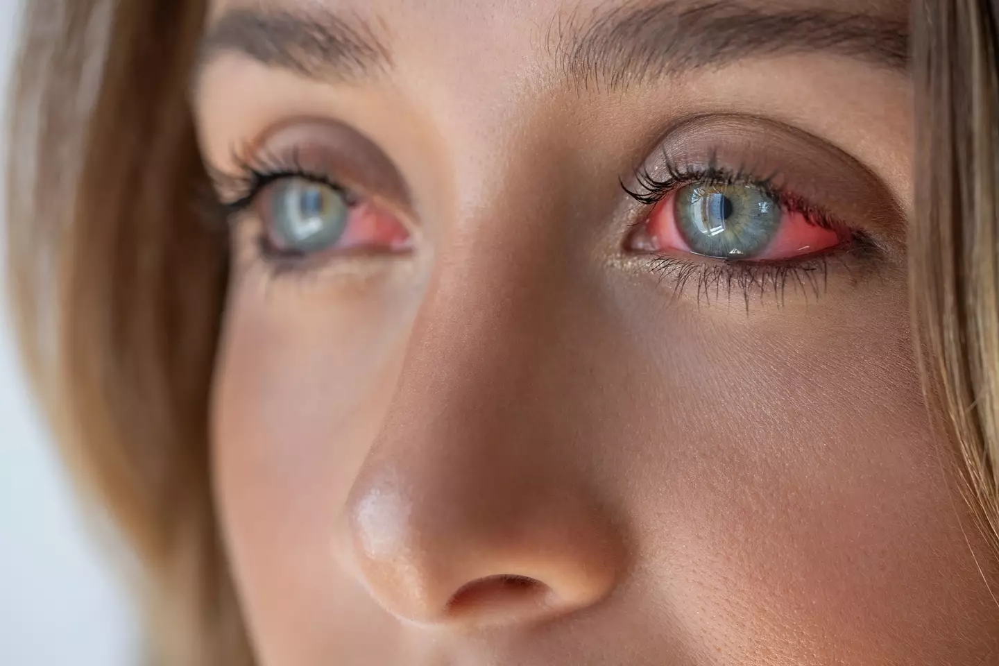A young woman suffering from bloodshot eyes (Getty Stock Images)