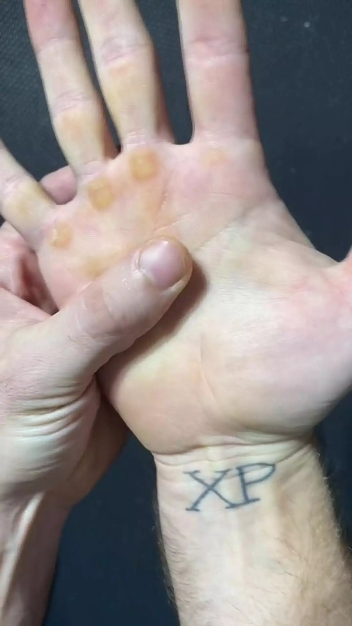 The only negative side effect has been calluses on his hands.