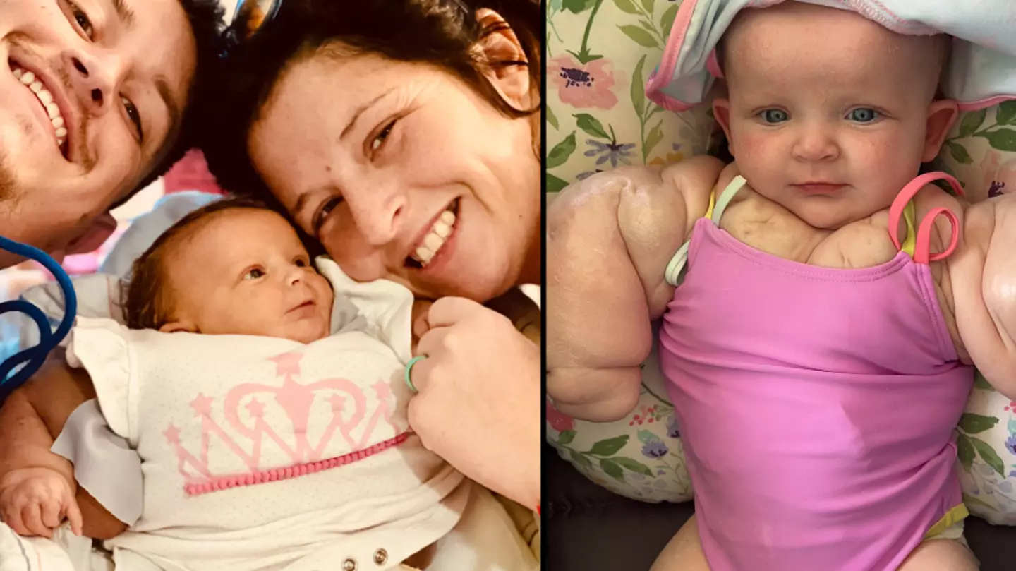 Baby gets dubbed ‘Mini Hulk’ after rare condition leaves her with huge biceps