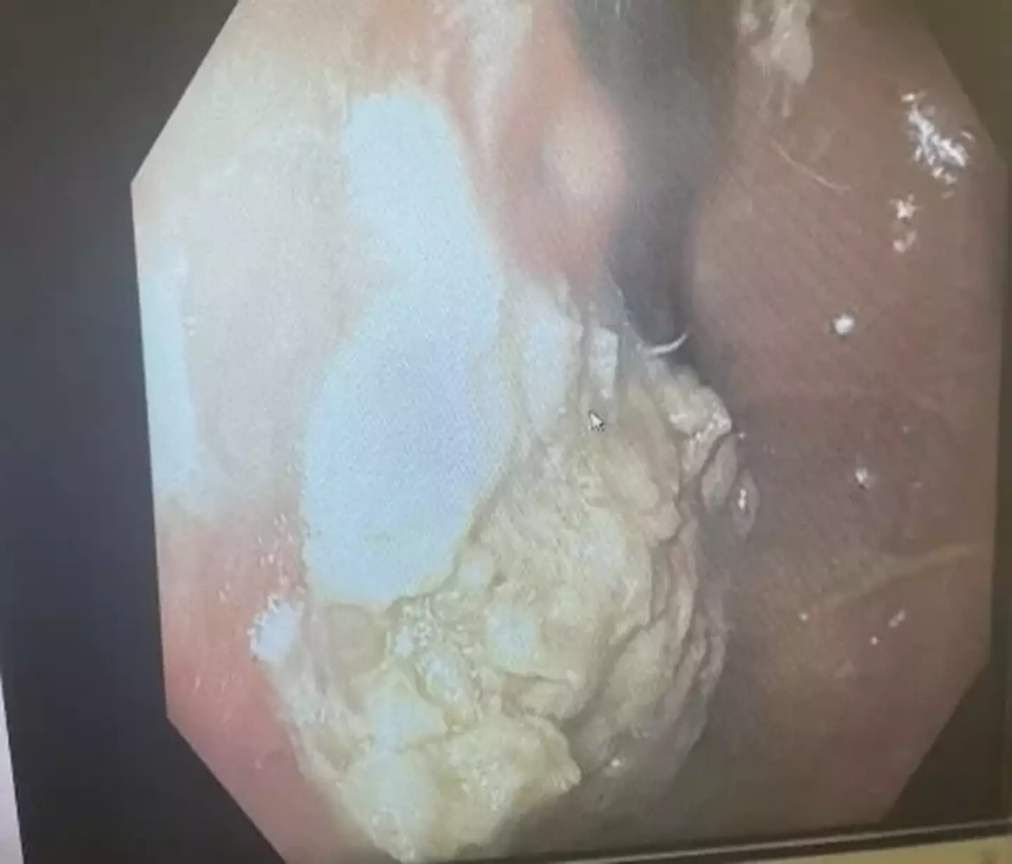 Doctors were able to remove the mass of chewing gum.