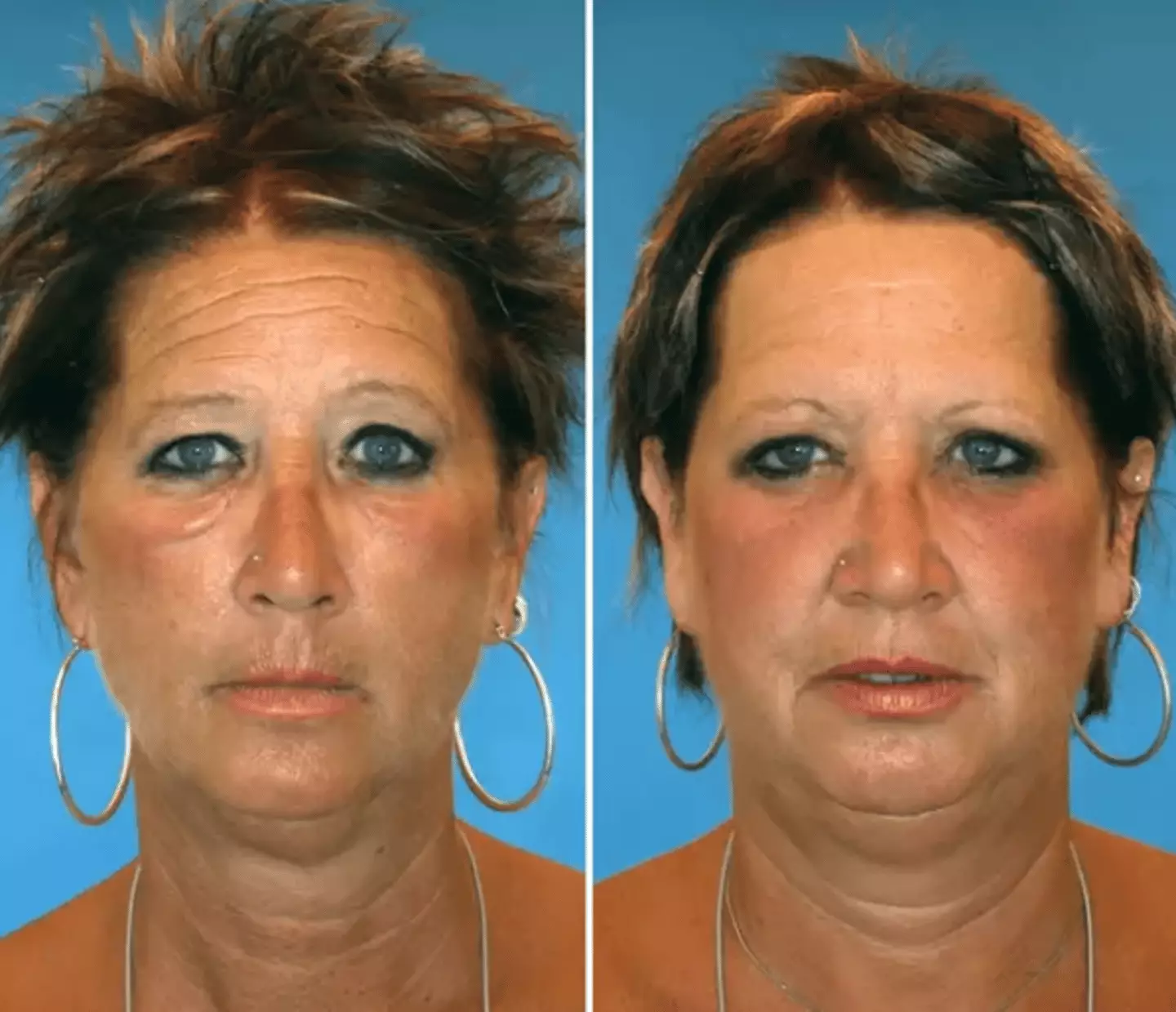"The festoons of loose skin' under Brenda’s (left) eyes are down to her smoking habit," Dr Guyuron said (NBC)