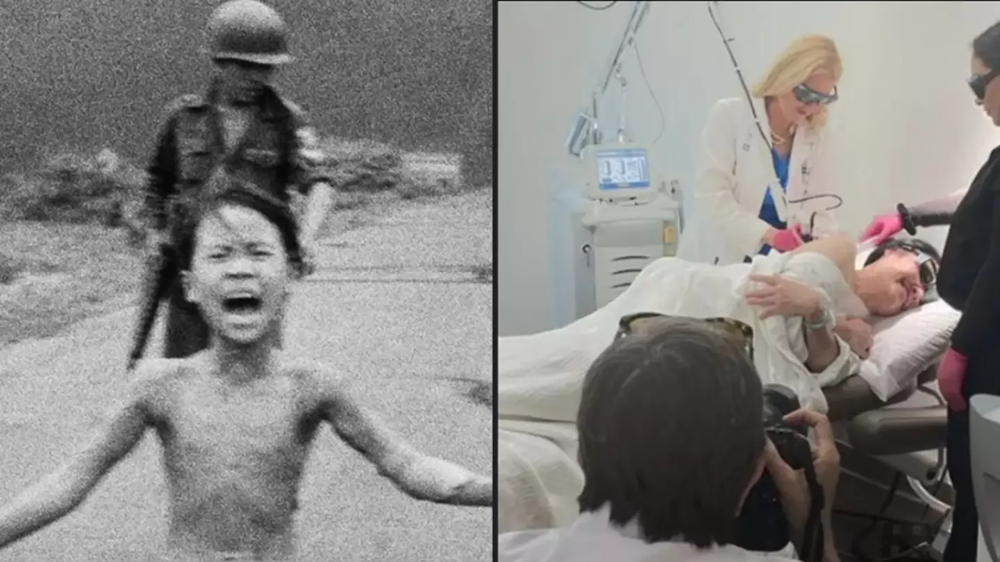 Vietnam War 'Napalm Girl' Gets Final Burn Treatment 50 Years After Horrific Moment