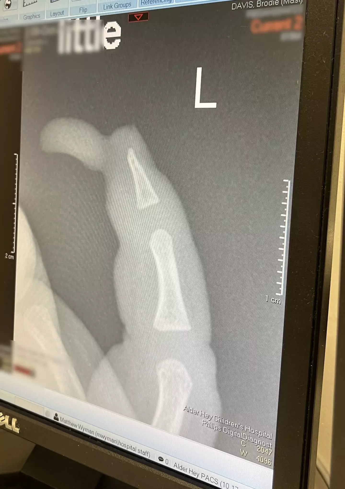 The tip of the toddler's finger had to be surgically reattached, and he may need a skin graft in the future. (Kennedy News and Media)